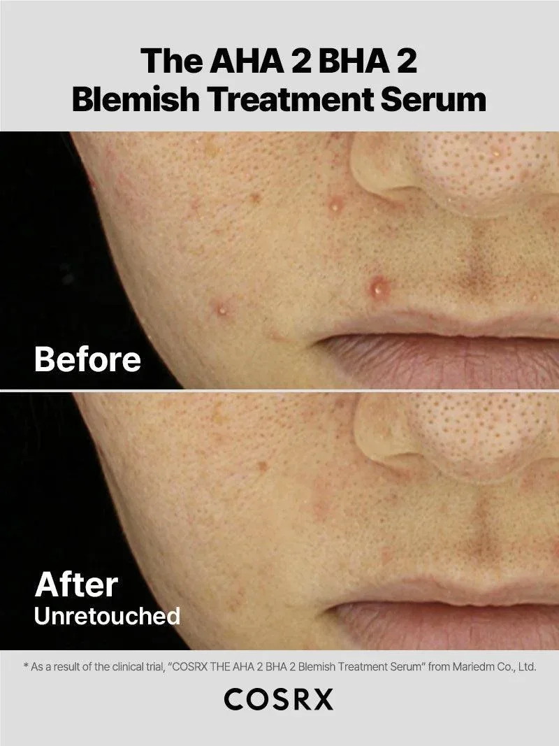 The AHA 2 BHA 2 Blemish Treatment Serum product view