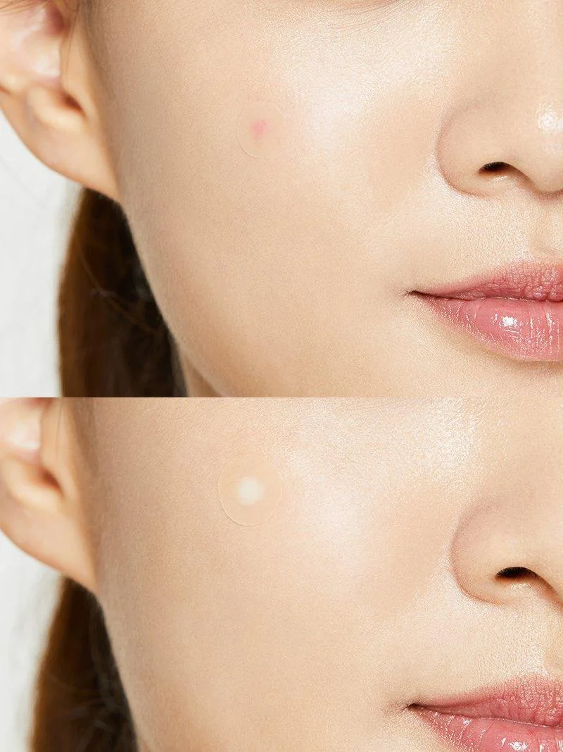 Acne Pimple Master Patch product view